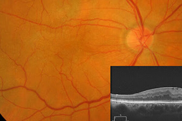 Epiretinal Membran