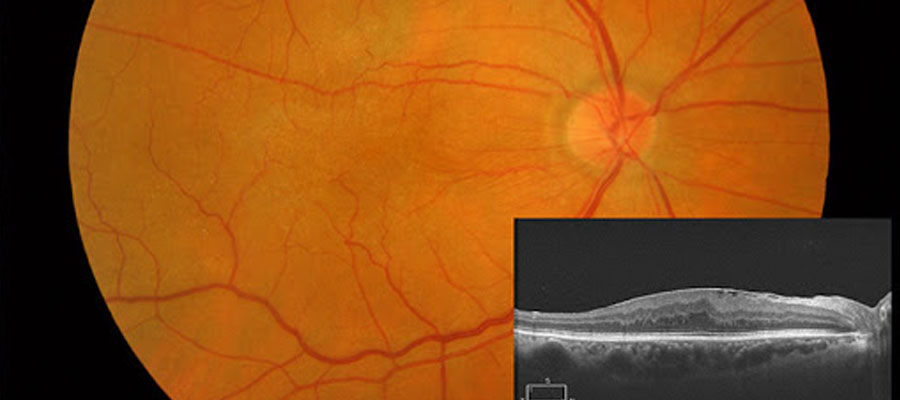 Epiretinal Membran