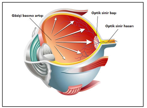 Glaucoma (Eye Pressure)