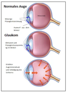 Glaukom (Augendruck)