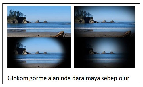 Glaucoma (Eye Pressure)