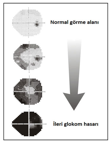 Glokom (Göz Tansiyonu)