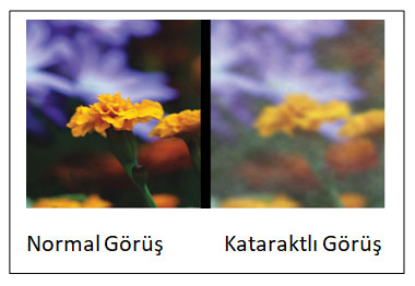 Katarakt Tedavisi