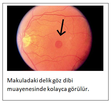 Makula Deliği
