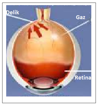 Makula Deliği