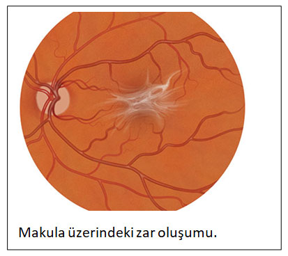 Epiretinal Membran