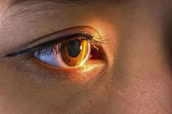 Retinal Ven (Toplardamar) Tıkanıklığı