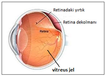 Retina Dekolmanı
