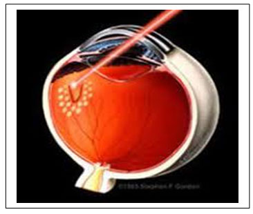 Retina Dekolmanı