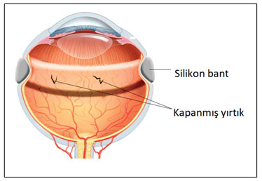 Retina Dekolmanı