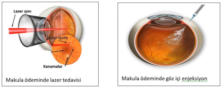 Retinal Ven (Toplardamar) Tıkanıklığı