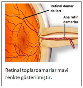 Retinal Ven (Toplardamar) Tıkanıklığı
