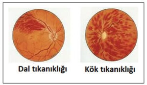 Retinal Ven (Toplardamar) Tıkanıklığı