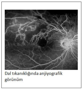 Retinal Ven (Toplardamar) Tıkanıklığı