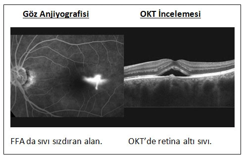 Santral Seröz Retinopati
