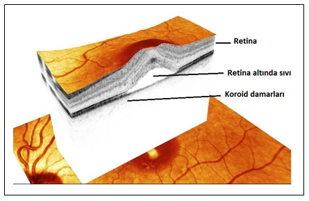 Santral Seröz Retinopati