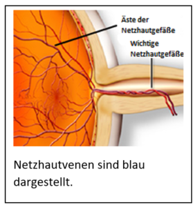 Netzhautvene (Vene) Okklusion