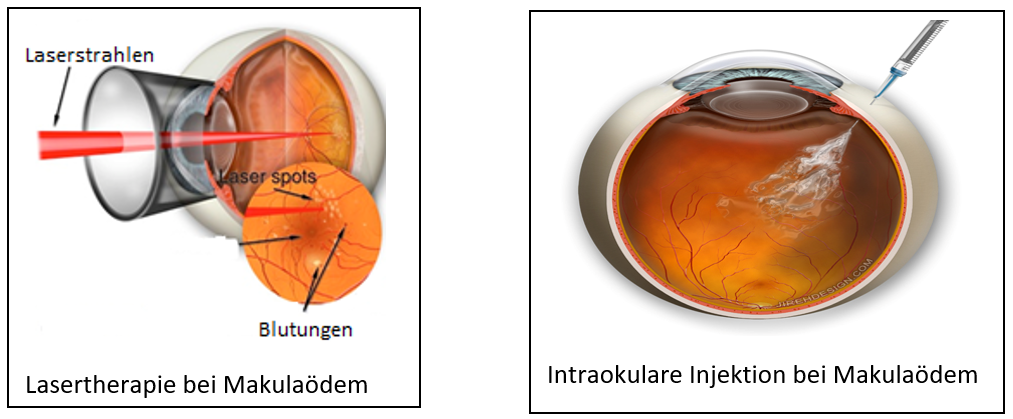 Netzhautvene (Vene) Okklusion