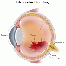 Intraocular Hemorrhage