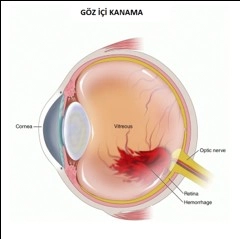 Göz İçi Kanamaları