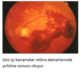 Göz İçi Kanamaları