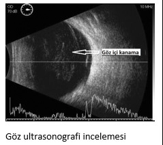 Göz İçi Kanamaları