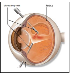 Intraocular Hemorrhage