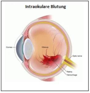Intra Okulare Blutung