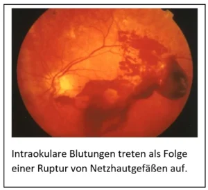 Intra Okulare Blutung