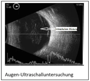Intra Okulare Blutung