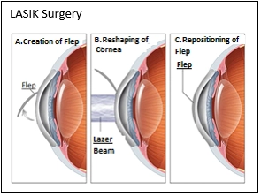 LASIK-Laser Eye Surgery