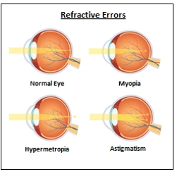 LASIK-Laser Eye Surgery