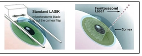 LASIK-Laser Eye Surgery