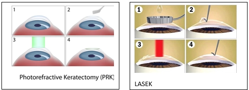 LASIK-Laser Eye Surgery