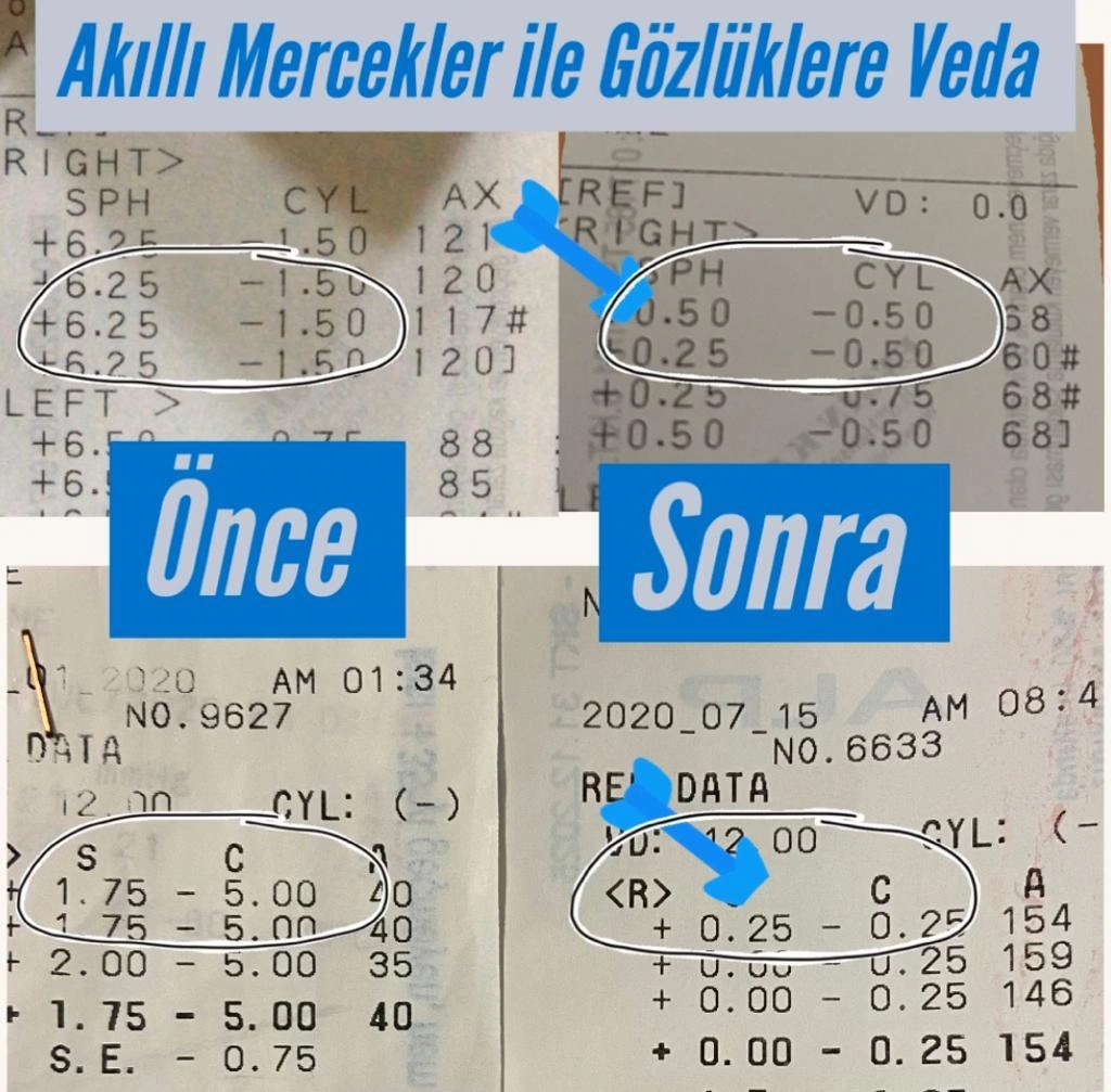 Akıllı Lens