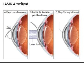 Lasik Göz Ameliyatı