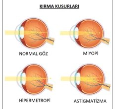 Lasik Göz Ameliyatı