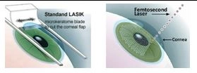 Lasik Göz Ameliyatı