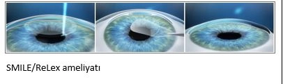 Lasik Göz Ameliyatı