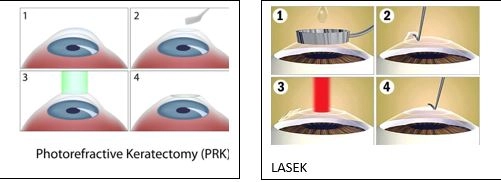 Lasik Göz Ameliyatı