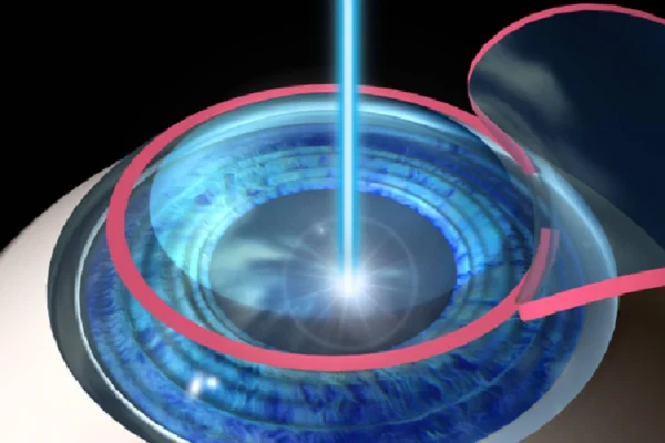 Lasik Göz Ameliyatı