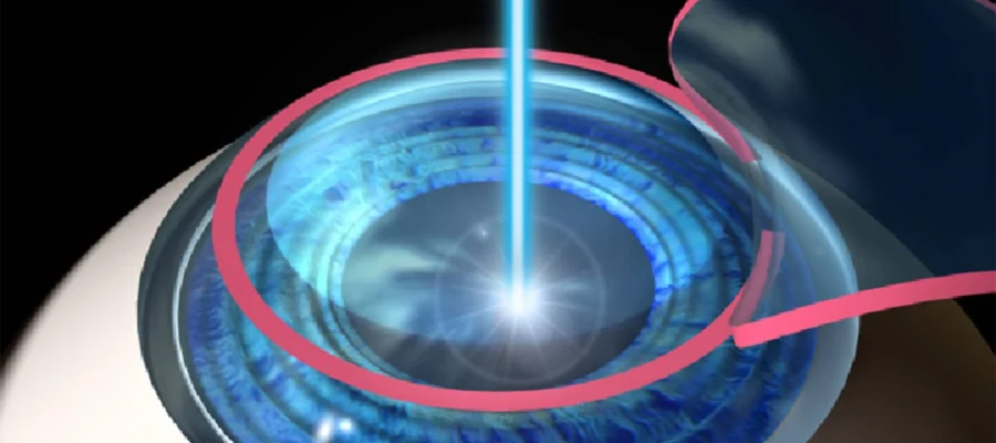 Lasik Göz Ameliyatı
