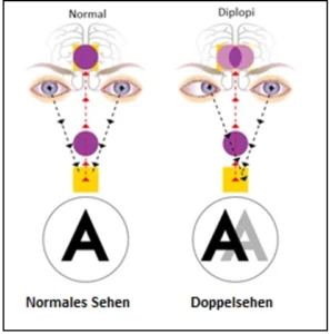 Was ist Doppelsehen (Diplopie)?