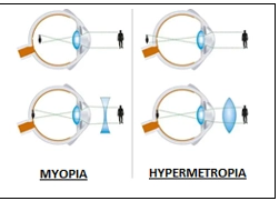Astigmatism and Hyperopia