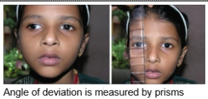 Strabismus Surgery
