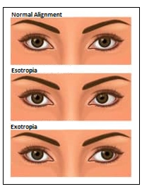 Strabismus Surgery