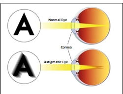 Astigmatism and Hyperopia