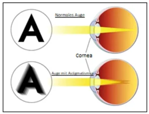 Astigmatismus und Hyperopie