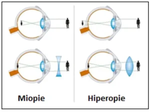 Astigmatismus und Hyperopie