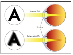 Astigmat ve Hipermetrop
